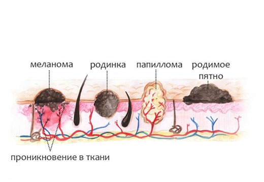 Отличия и общие черты между родинкой и папилломой