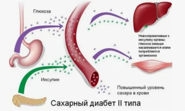 Что нужно знать о сахарном диабете 2 типа