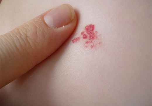 ¿Cuáles son las causas y significado de los lunares (nevos) rojos (hemangiomas)?