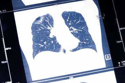 The oncologist spoke about the late detection of lung cancer in about 70% of patients