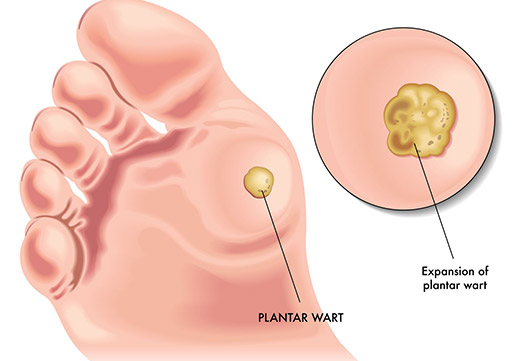 Что такое подошвенная бородавка: причины появления
