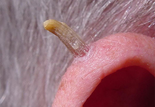 Verrugas seniles (queratosis seborreicas): caracterización, tipos y métodos de tratamiento