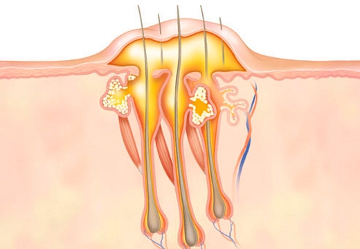Опасность образования гнойных фурункулов и причины появления