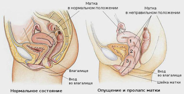 Выпадение матки